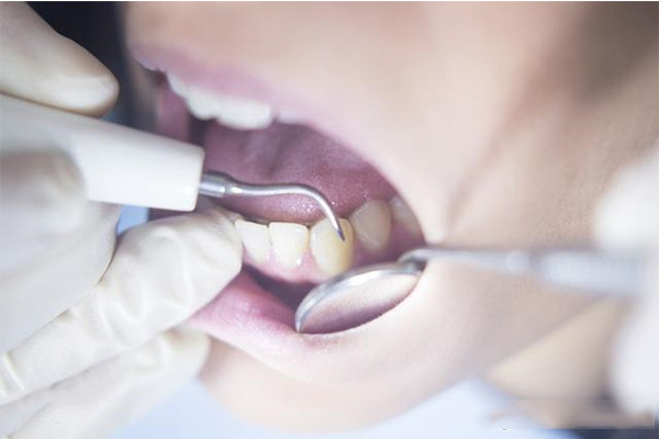 拔牙后2小时就能吃饭？中老年口腔揭