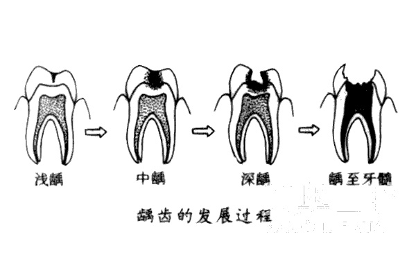 中老年口腔：蛀牙黑斑别忽视，批量