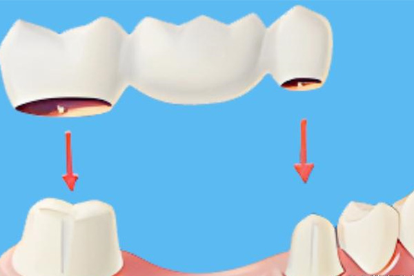 老年人牙齿掉了多长时间可以镶牙好