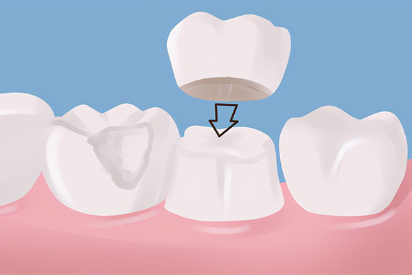 牙齿缺失怎么办？中老年口腔为您高