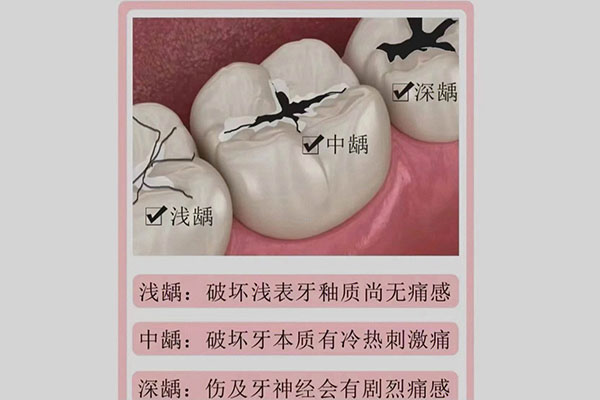 中老年人蛀牙到底该不该补？一文说