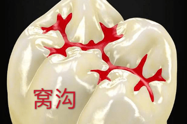 揭秘洁牙后涂氟真相：中老年口腔患