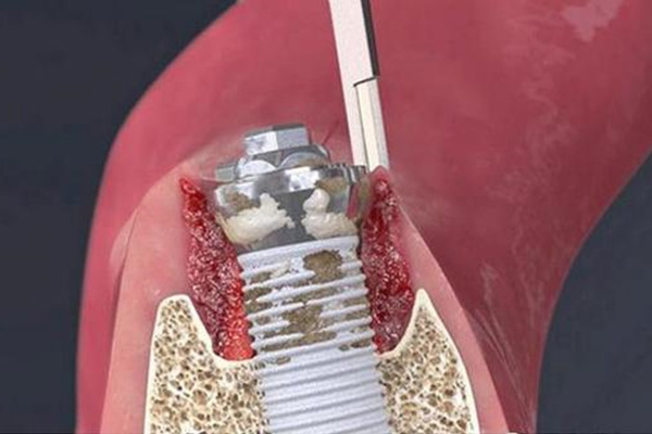 种牙什么时候装基台比较好