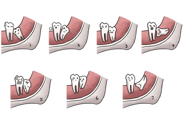 昆明拔智齿可以用医保吗？中老年口
