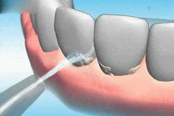 经常洗牙真的对牙齿有好处吗？中老