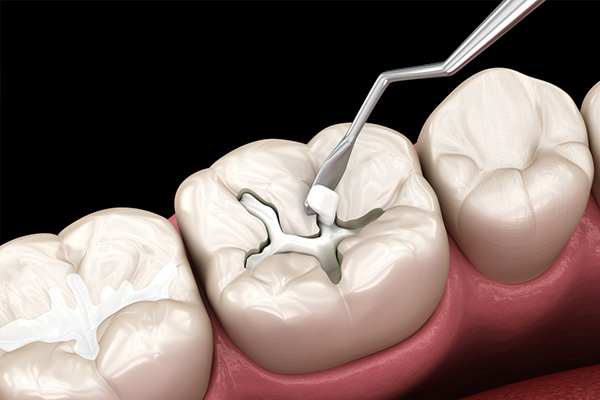 中老年口腔专家：涂氟对牙齿真的有