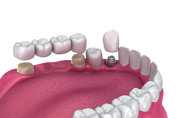 北京种牙医院排名：中老年口腔如何快速解决牙齿缺失问题？