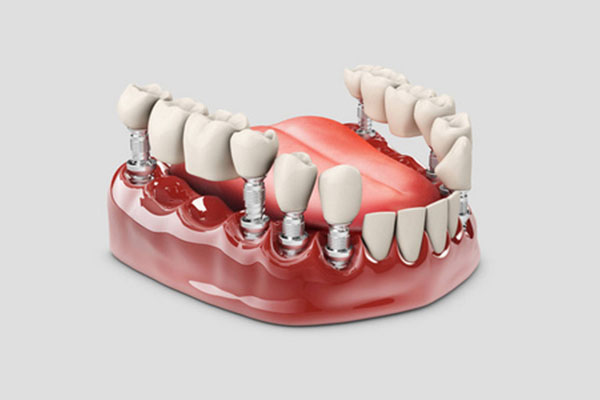 种牙选择正规医院还是诊所？中老年