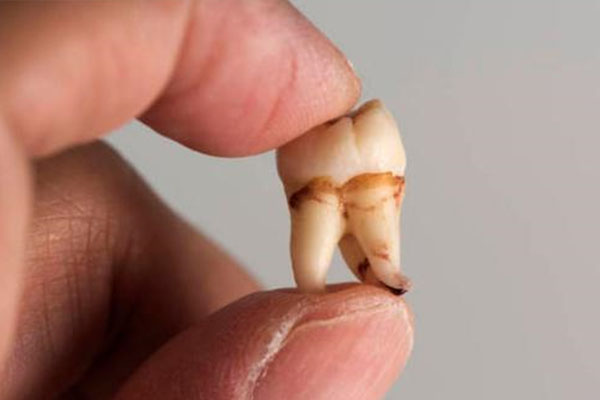 牙科私人贵还是医院贵拔智齿好些