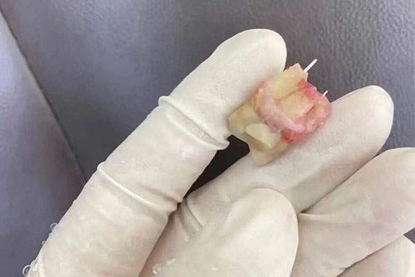 为什么中老年口腔专家建议及时拔除智齿横生？过程详解！