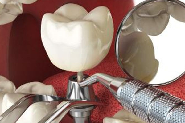 中老年人缺牙困扰多 选对种植牙方案才靠谱