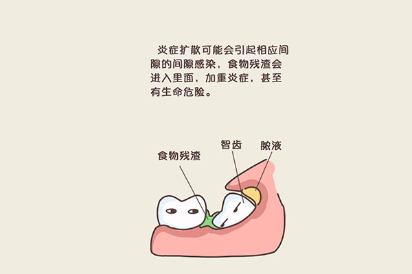 中老年人有一点点蛀牙需要立刻补吗？牙医告诉你这3种情况必须