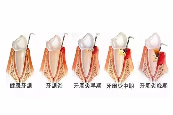 牙周炎反复发作？中老年口腔专业方案助您轻松解决！