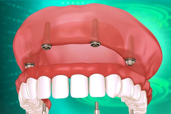 老年种牙可以报销吗？中老年口腔批量种牙效率高还能帮你省更