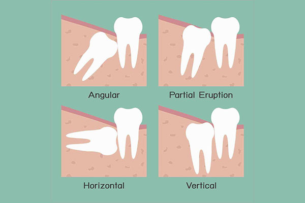 牙医亲戚说智齿不能拔？中老年口腔