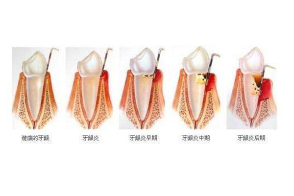 中老年口腔：慢性牙髓炎急性发作，如何快速缓解并恢复健康？