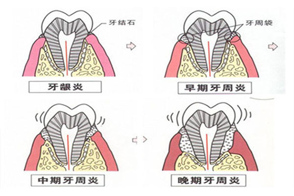 牙周炎是怎么来的？中老年口腔告诉