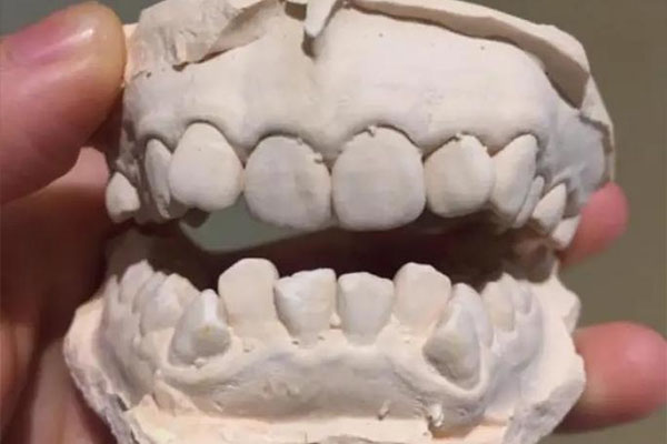 活动假牙有哪些种类？一文看懂中老年口腔修复全攻略