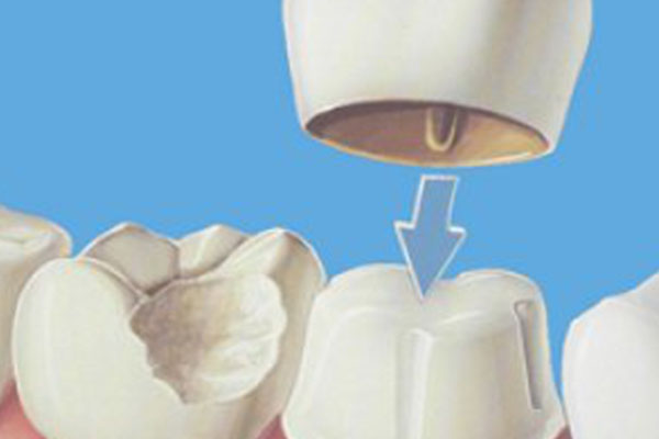 补牙缝需要多长时间恢复？中老年口