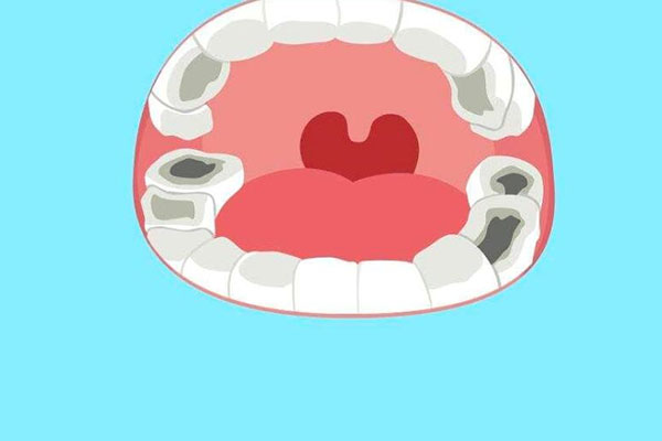 蛀牙如何让它停止腐蚀？这些土方法