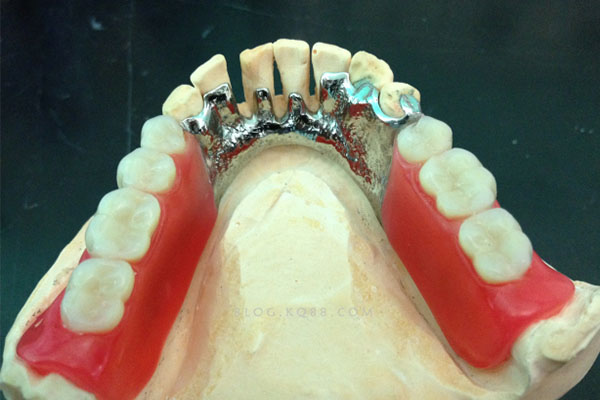 中老年口腔揭秘：活动义齿多久能拿