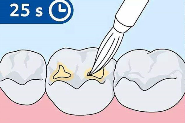 牙齿涂氟可以用医保吗？中老年口腔