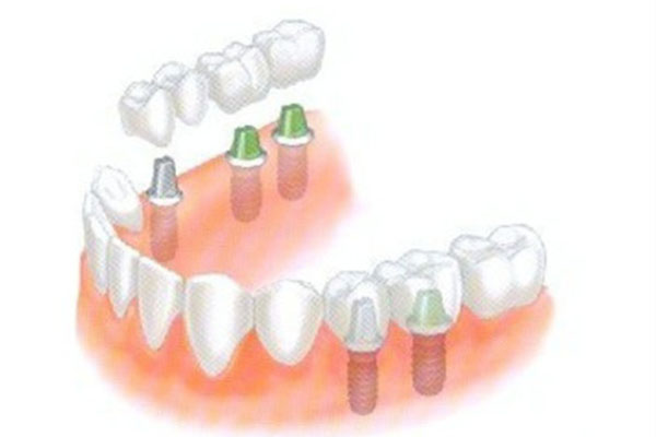 种牙选医院还是诊所？中老年口腔为您高效解决！