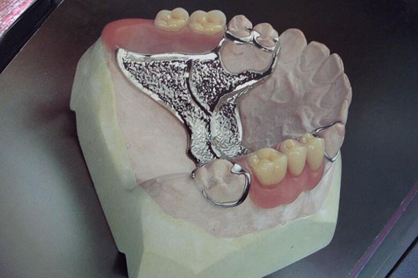 做一套活动假牙多少钱？中老年口腔为您解答舒适又经济的选择