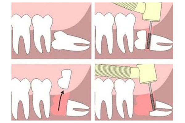 没长出来的横生智齿怎么拔？中老年口腔专家教你安全高效解决