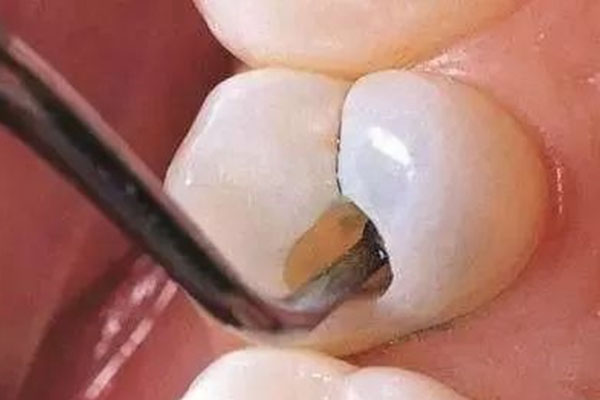 补牙材料掉了洞大还要磨吗？中老年