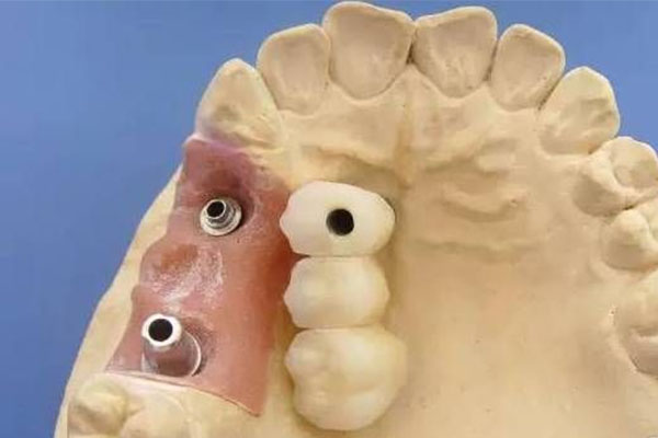 中老年口腔：活动假牙用一天一洗吗？科学护理方法揭秘