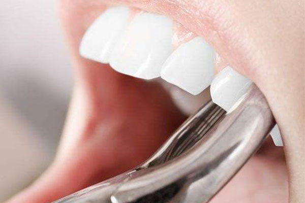 中老年缺牙患者必看：拔牙后几天拆