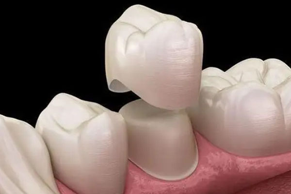 门牙缝大怎么补要多少钱？中老年口