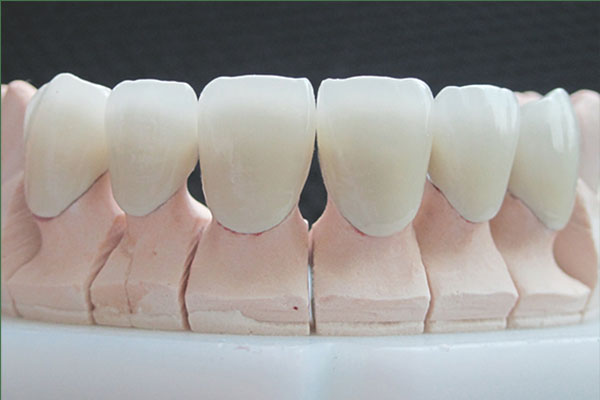 牙套烤瓷冠能用多久？中老年口腔为