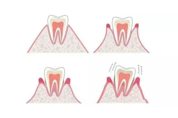 13岁牙齿松动正常吗？中老年口腔为您解析换牙期的那些事儿
