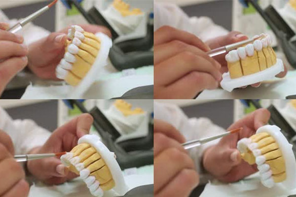 中老年口腔：活动义齿的工艺流程和优点解析，轻松解决缺牙烦