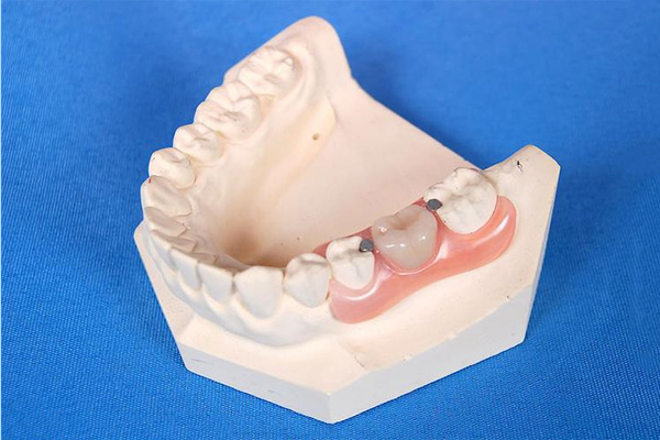 种植义齿上部结构有哪些类型？中老年口腔为您详解5种解决方案