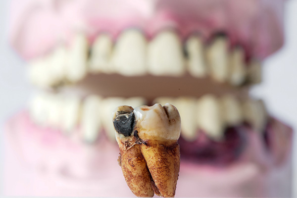 拔牙智齿需要多长时间？中老年口腔为您高效解决缺牙难题