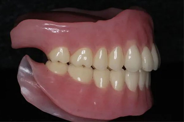 活动义齿总脱落？中老年口腔专业定制稳固不掉牙 吃饭说话更安