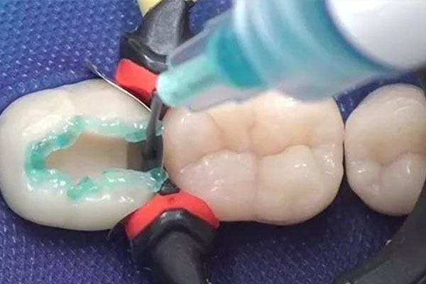 刷牙方法错竟致牙残缺？中老年口腔揭秘补牙真相