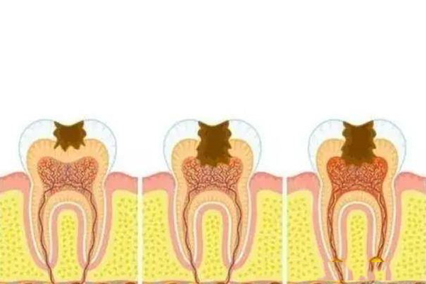补牙到底疼不疼？中老年口腔揭秘无痛修复真相