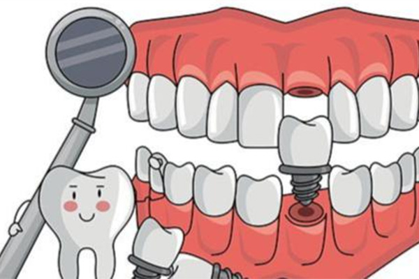 牙齿掉完了别愁，假牙还是种牙怎么选？价格全解析