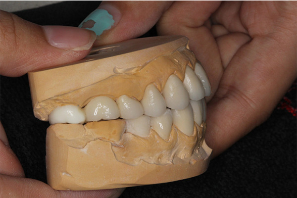 中老年口腔：活动假牙价格是多少？
