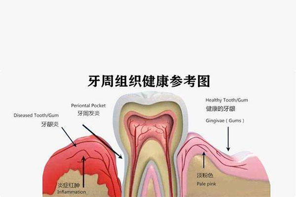 中老年口腔推荐：牙周修复脱敏凝胶