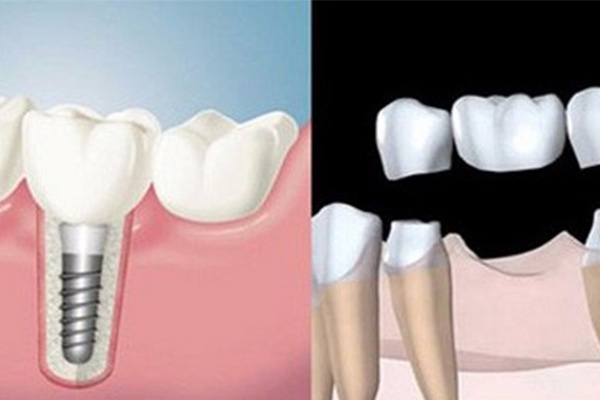 拔牙种牙可以用医保报销吗多少