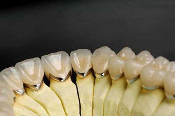 大牙做牙冠多少钱一颗？中老年口腔