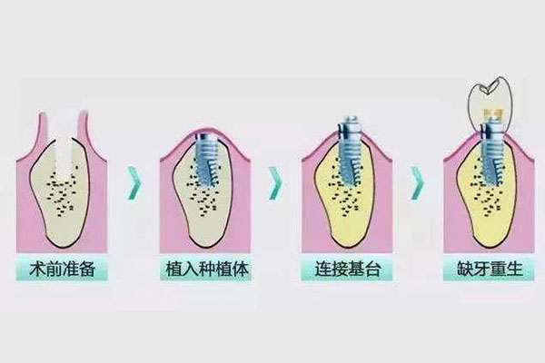 种牙多少钱一颗？中老年口腔高效种牙方案，上海人民医院患者