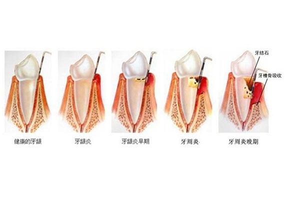 牙周炎治疗一次多少钱？中老年口腔