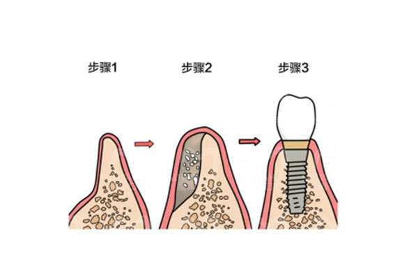 中老年种牙必看：一期二期全过程详解，告别缺牙烦恼轻松享受