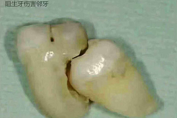 怎么知道长智齿了没有